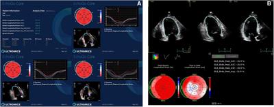 Clinical service evaluation of the feasibility and reproducibility of novel artificial intelligence based-echocardiographic quantification of global longitudinal strain and left ventricular ejection fraction in trastuzumab-treated patients